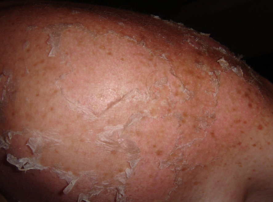 5 Sunburns Increase Your Odds of Skin Cancer ATTN